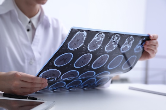 Viz.ai expands into multiple sclerosis with Cortechs.ai imaging deal