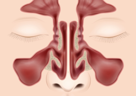 Firstword Dupixent's ninth US nod addresses uncommon sinus disease subtype ...