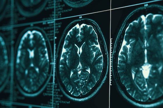 AI tops brain tumour experts while slashing diagnosis wait times