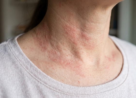 Cue touts Phase II hives data for Xolair challenger, but shares tumble