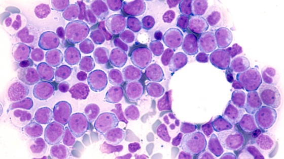 Akeso spotlights AML data for anti-CD47 mAb ahead of EHA