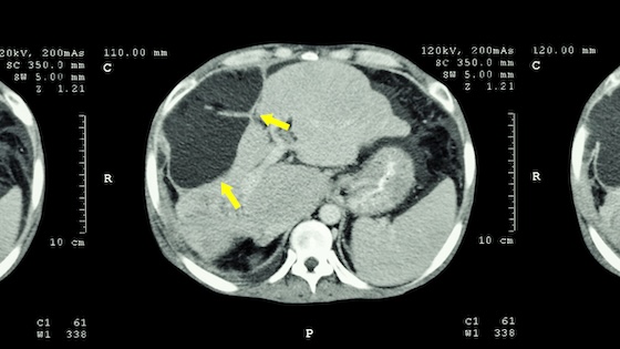 ASCO26: AstraZeneca's HCC quad cuts progression risk, but OS picture less clear