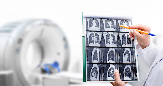 Median Technologies' AI tool wins EU nod for earlier lung cancer detection