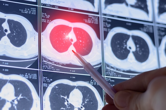 WCLC26: GSK's ris-rez cuts death risk 54% in Phase III lung cancer trial