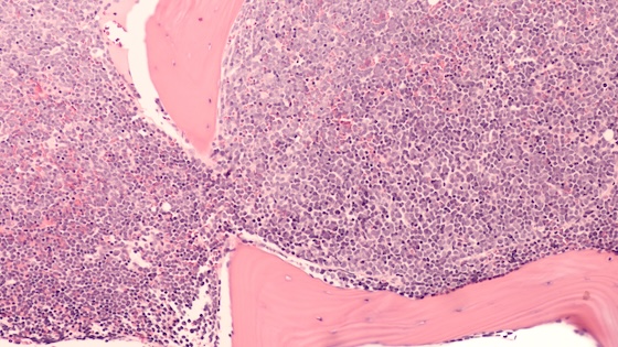 ASCO26: Incyte's Monjuvi shows survival gains in untreated blood cancer