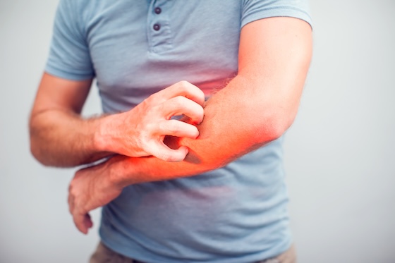 Priovant's TYK2/JAK1 inhibitor wins FDA nod as first oral drug for dermatomyositis