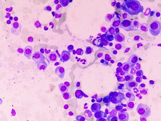ASCO26: AI tool helps guide treatment decisions in multiple myeloma
