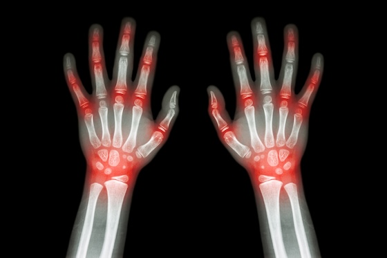 Spyre says its anti-TL1A works in rheumatoid arthritis, but still falls short in Phase II