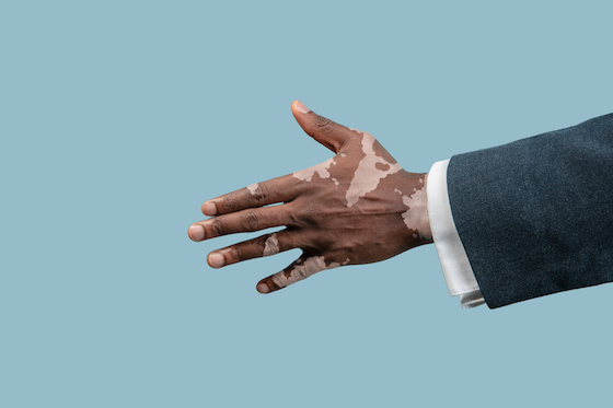 InnoCare set for pivotal test after positive mid-stage data for TYK2 inhibitor in vitiligo