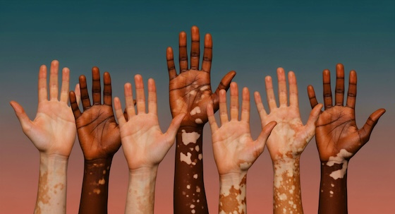 Pfizer unpacks Litfulo's Phase III vitiligo results ahead of US, EU filings