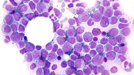 With mid-stage AML win, Kura details dual-track Phase III